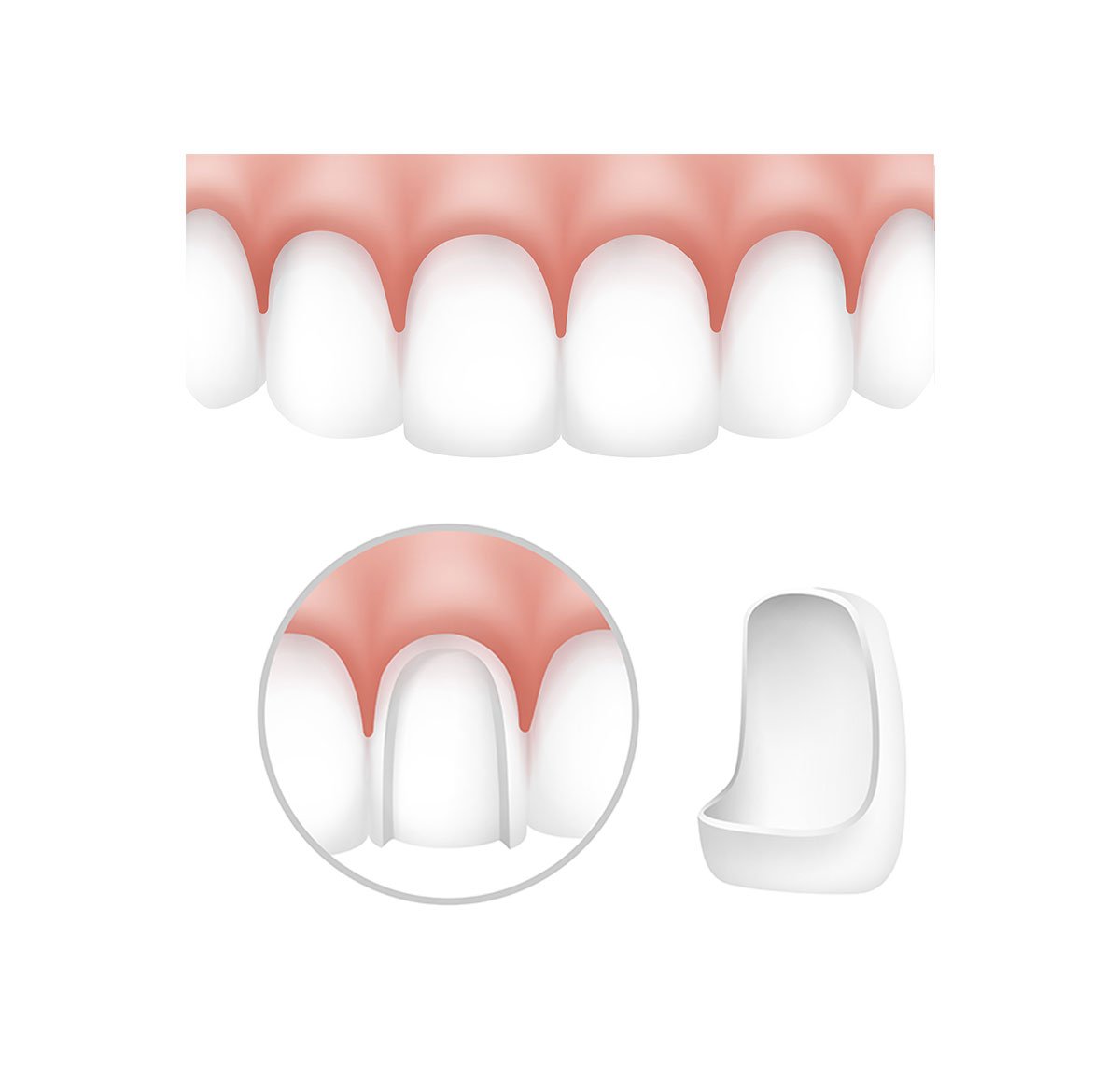 https://sunrisedentalclinic.ca/wp-content/uploads/2022/10/Ceramic-Veneers.jpg