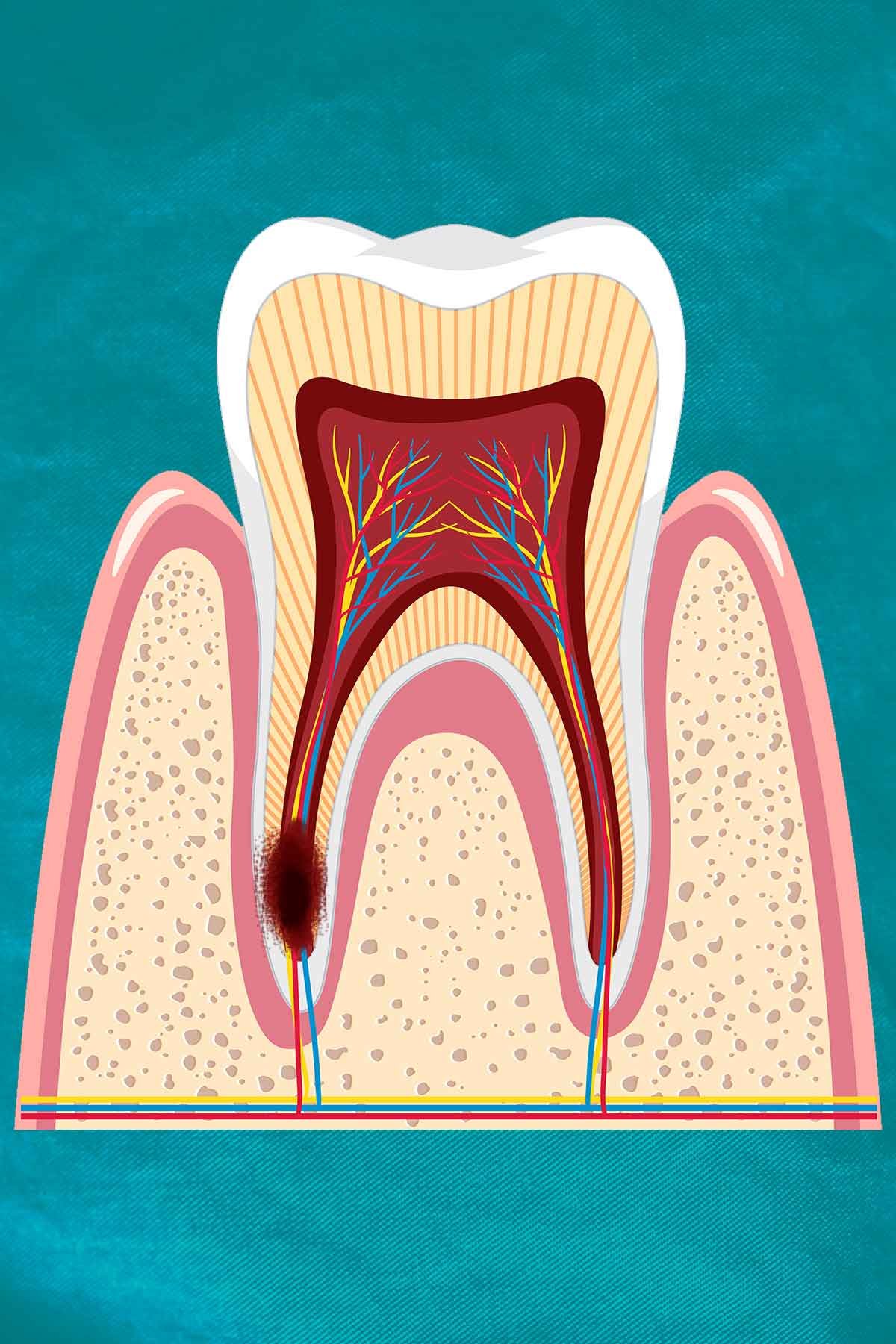 https://sunrisedentalclinic.ca/wp-content/uploads/2022/10/Root-Canal-Therapy.jpg