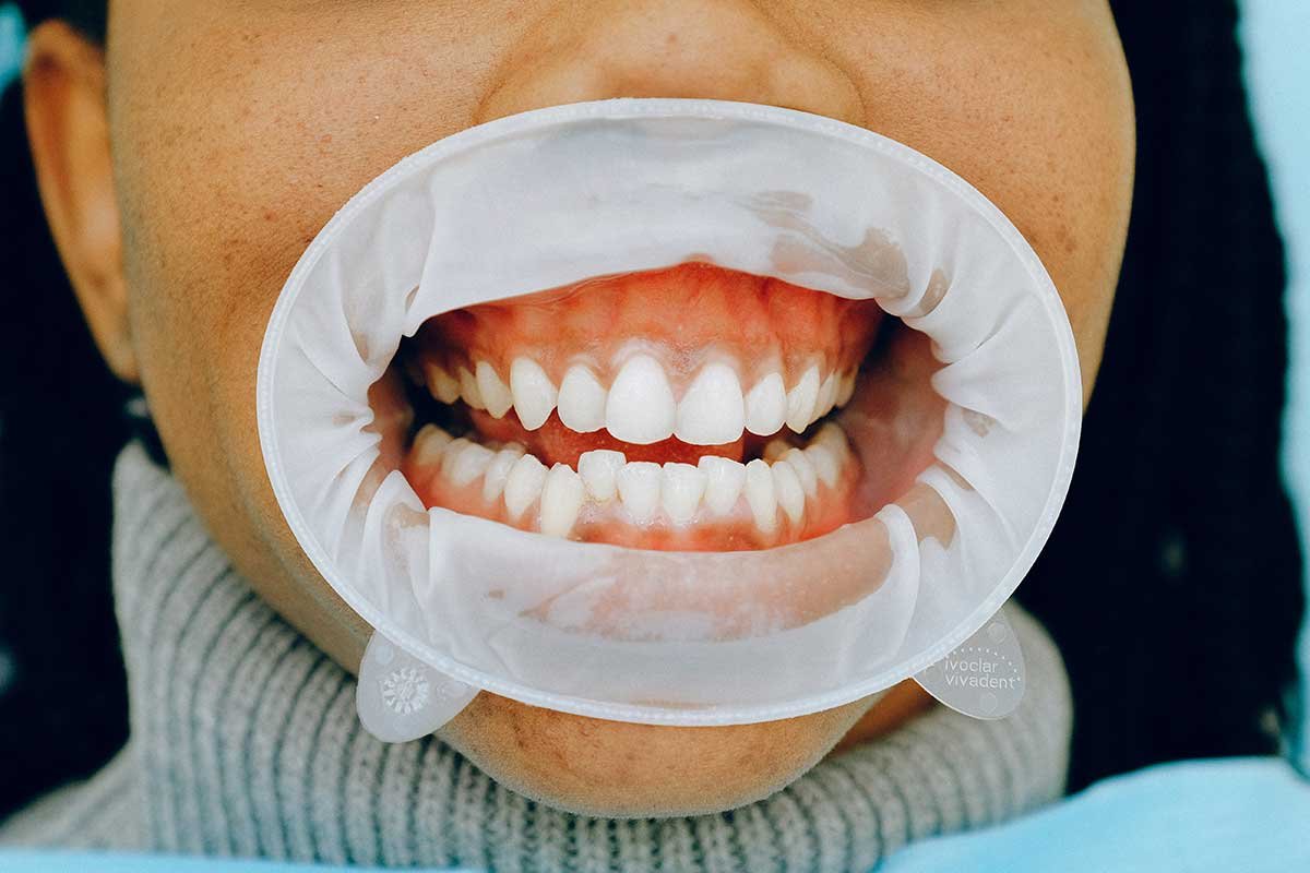 https://sunrisedentalclinic.ca/wp-content/uploads/2022/10/healthy-gums.jpg